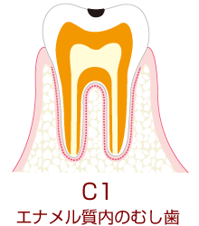 C1 エナメル質内のむし歯