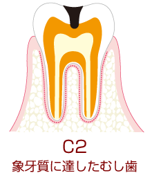 C2 象牙質に達したむし歯