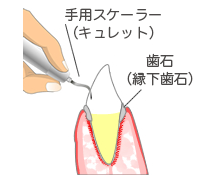 歯ぐきの下の歯石除去